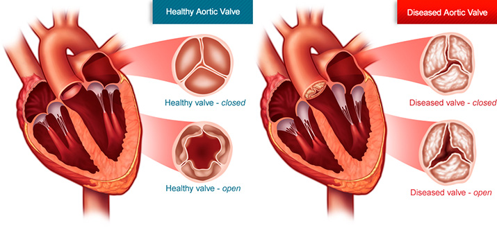 What is aortic stenosis