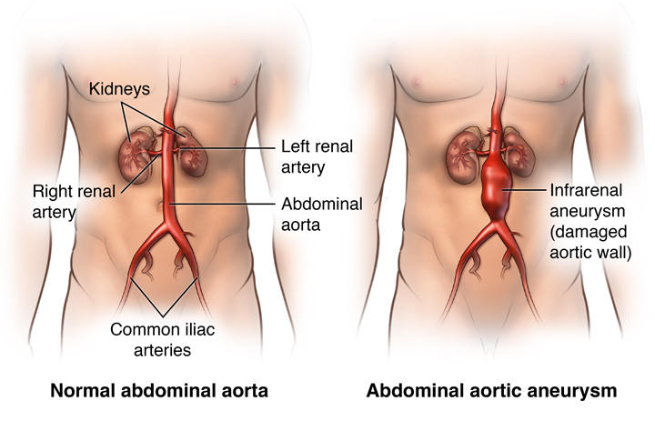 Abdominal Aortic Aneurysm