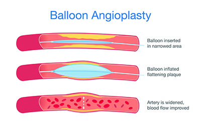 Balloon_Angio