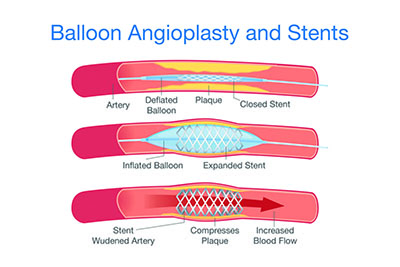 Balloon_Angio_Stent