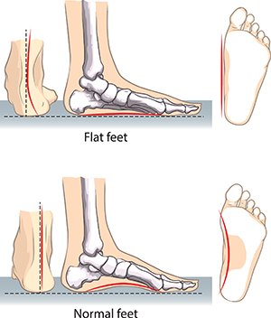 The image compares flat feet and normal feet, showing differences in arch structure and alignment.