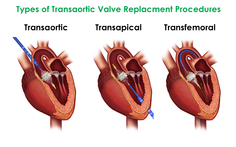 TAVR-version