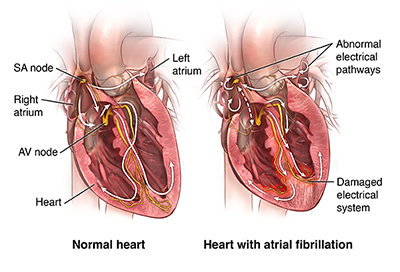 AFib