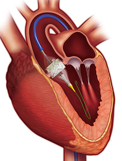 TAVR-valve-main