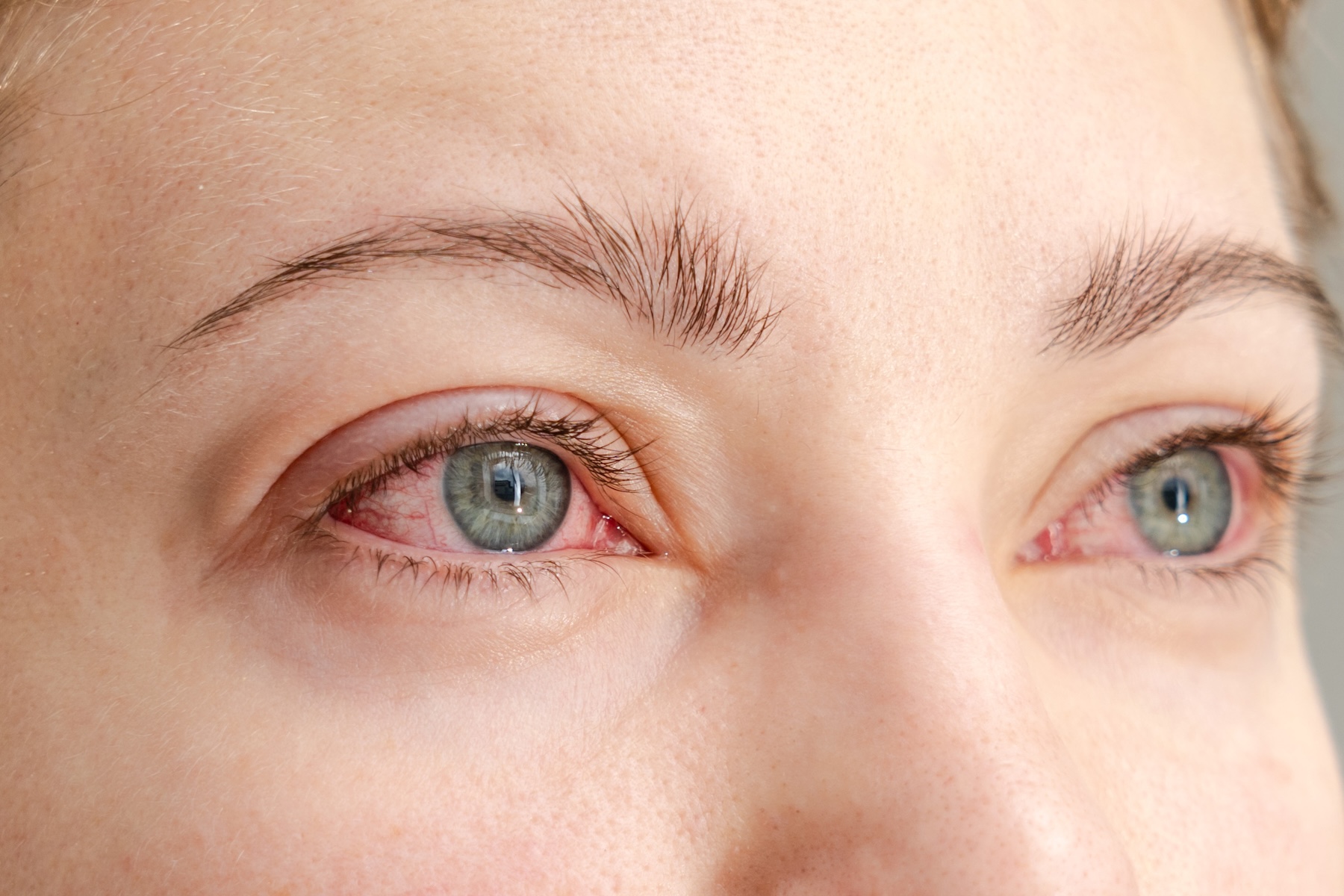 close up image of a woman with red blood-shot eyes